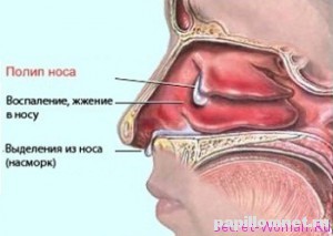 Фото схема появления полипов в носу, которые требуют лечения