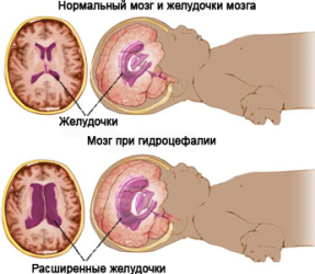 водянка головного мозга