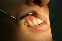 Воспаление кисты зуба