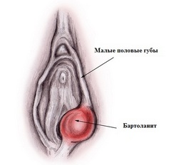 Киста бартолиновой железы