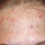 вылечить прыщи народными средствами