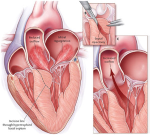 Удалении утолщенной части перегородки сердца