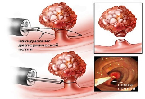 Удаление полипа