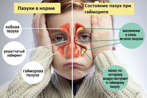 Здоровые и воспаленные гайморовы пазухи у ребёнка