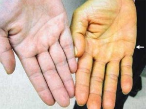 желтушность кожи рук