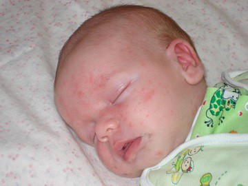 золотистый стафилакокк у новорожденных