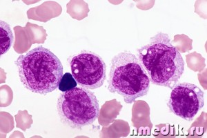 Лейкоз (лейкемия, рак крови, белокровие), лечение лейкоза