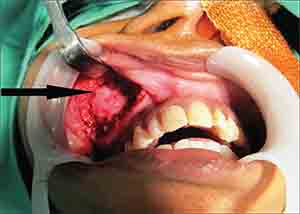 Хирургическое удаление кисты зуба