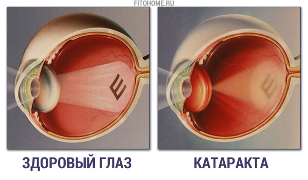 Катаракта. Причины и симптомы катаракты