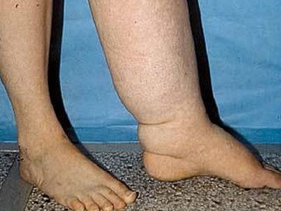  Лимфостаз левой ноги