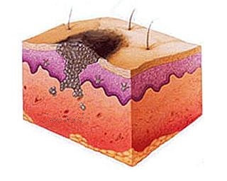 Рак кожи - лечение народными средствами