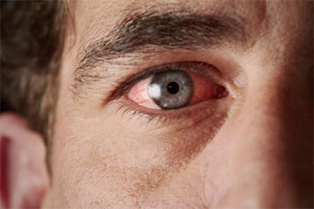 Саркоидоз глаз